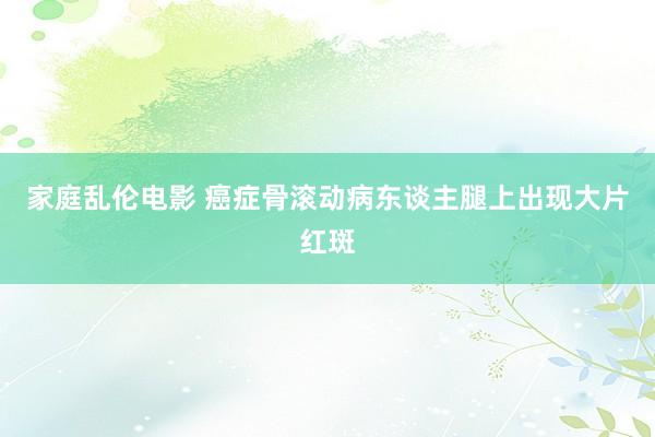 家庭乱伦电影 癌症骨滚动病东谈主腿上出现大片红斑